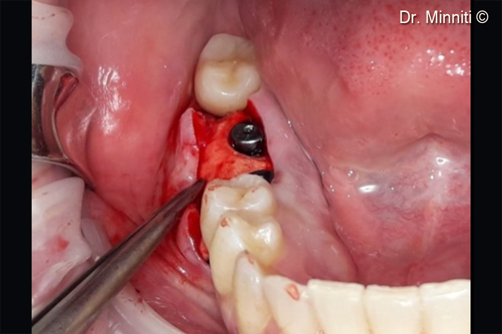 Derma 2 mm used to augment the soft tissues - lateral view
