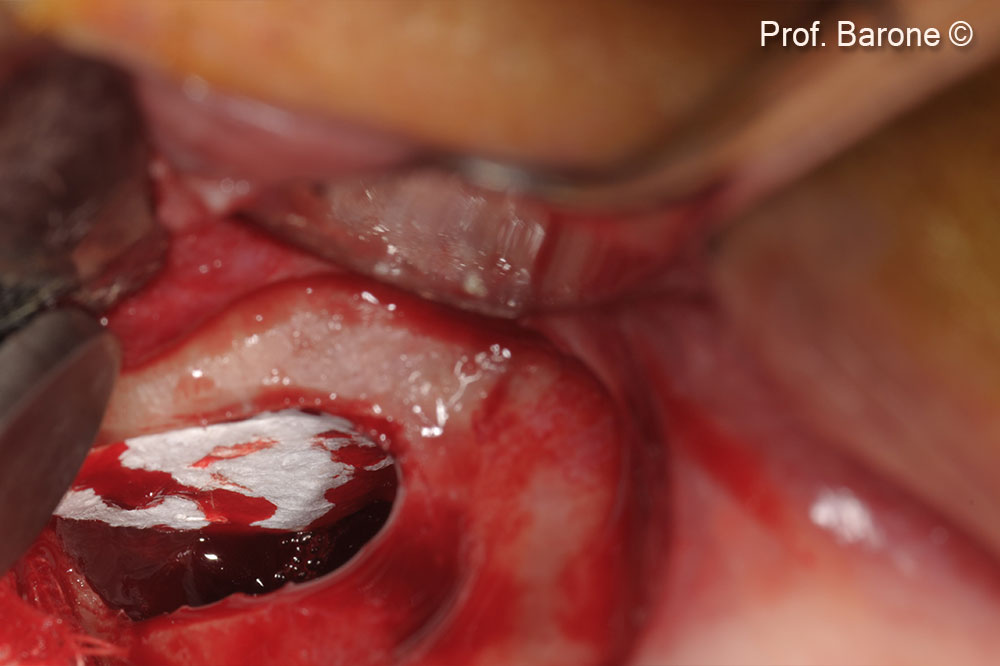 Maxillary Sinus membrane was raised and protected with Evolution