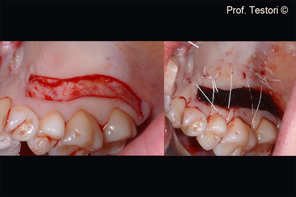 A connective tissue graft is harvested from the palate.