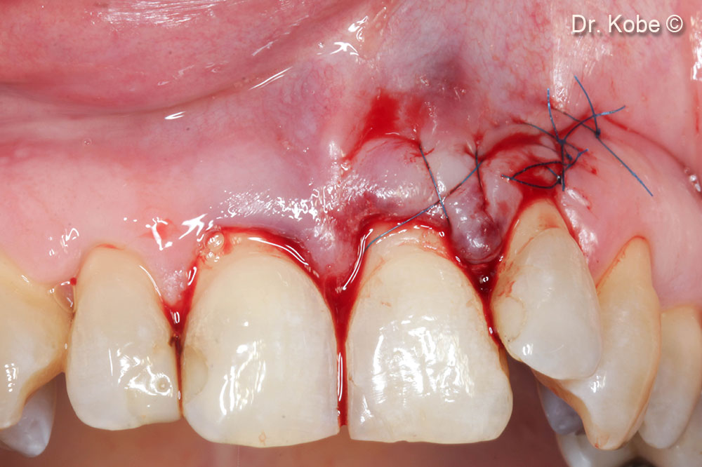 Wound closure with simple interrupted sutures