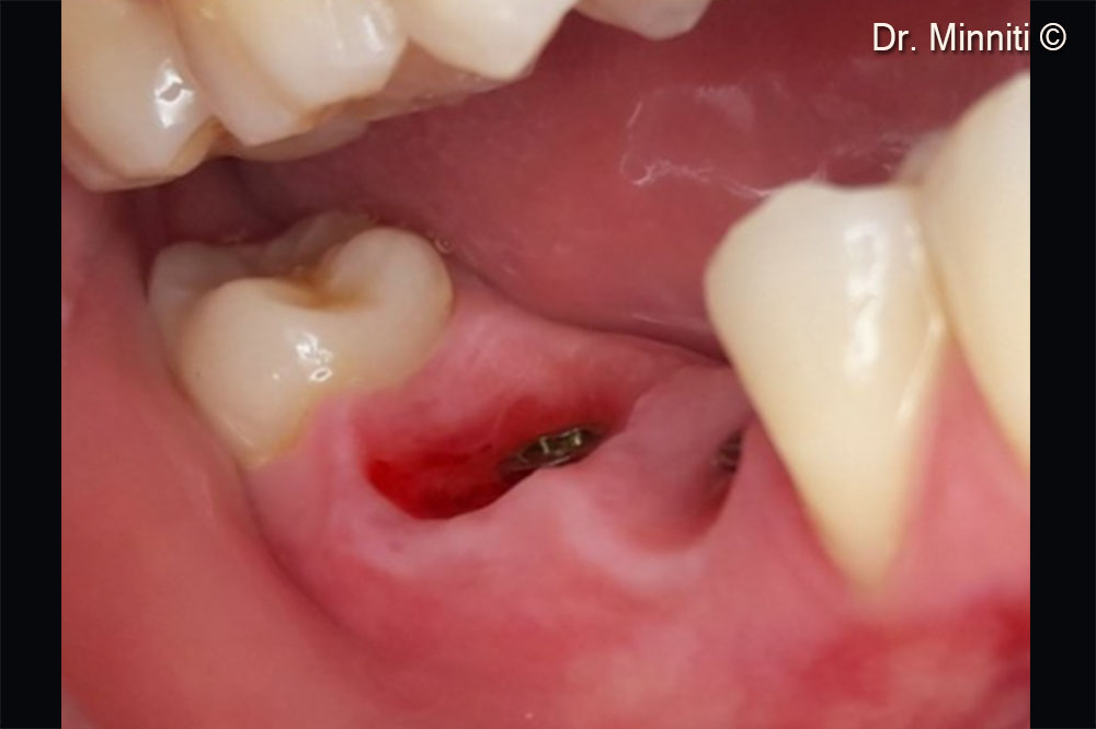 Soft tissues have been augment after the treatment - lateral view