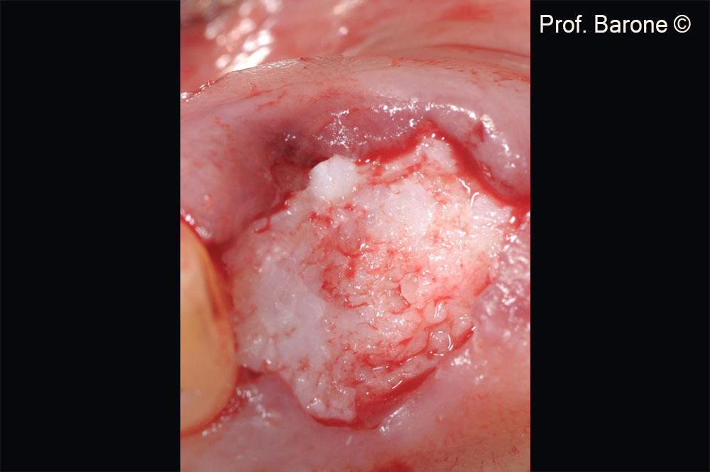 Extraction socket grafted with GTO®