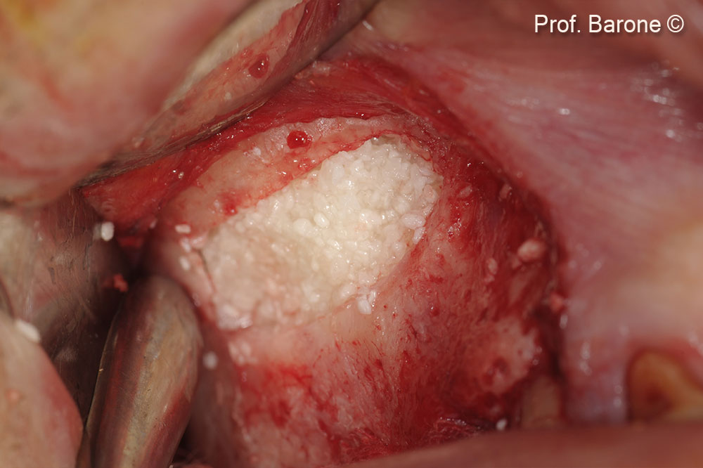 Maxillary Sinus grafted with GTO®