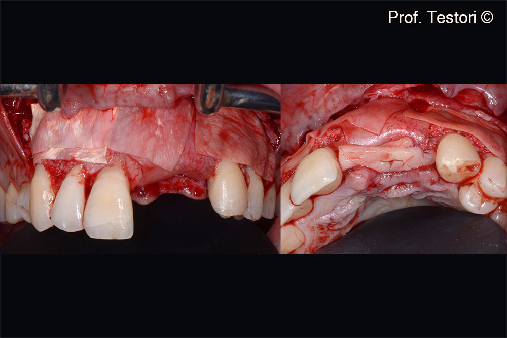 Evolution collagen membranes are used to protect the Lamina® from contamination. CTG is used according to the connective tissue platform protocol