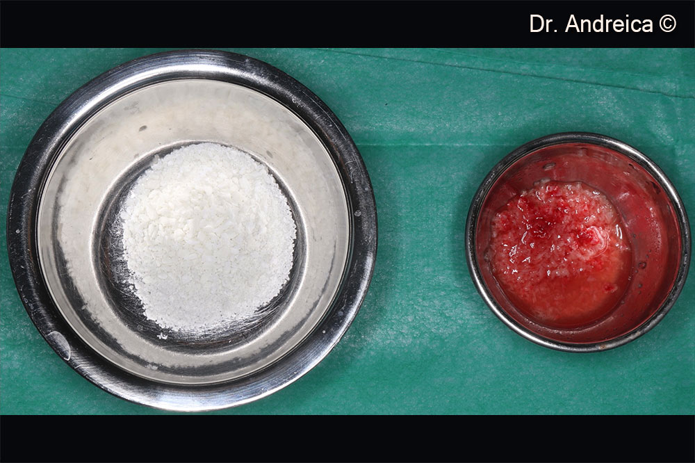 Biomaterials used for Horizontal augmentation:  Autologous bone + Gen-Os® and Apatos® 50/50  		         Sinus augmentation: Autologous bone + mp3® 40/60