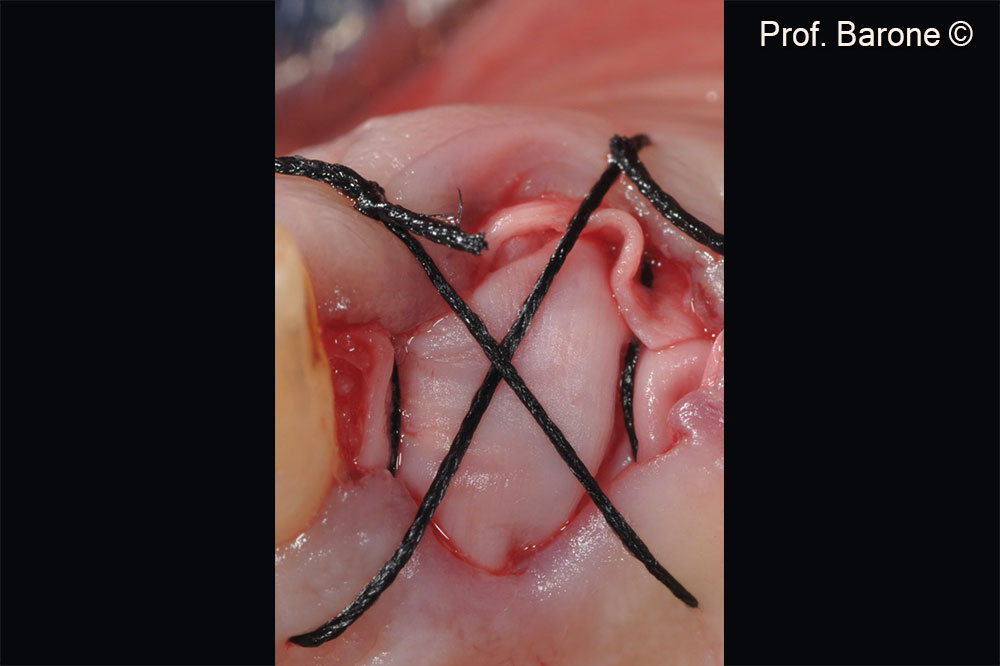 An Evolution collagen membrane was placed over the biomaterial to avoid granules loss