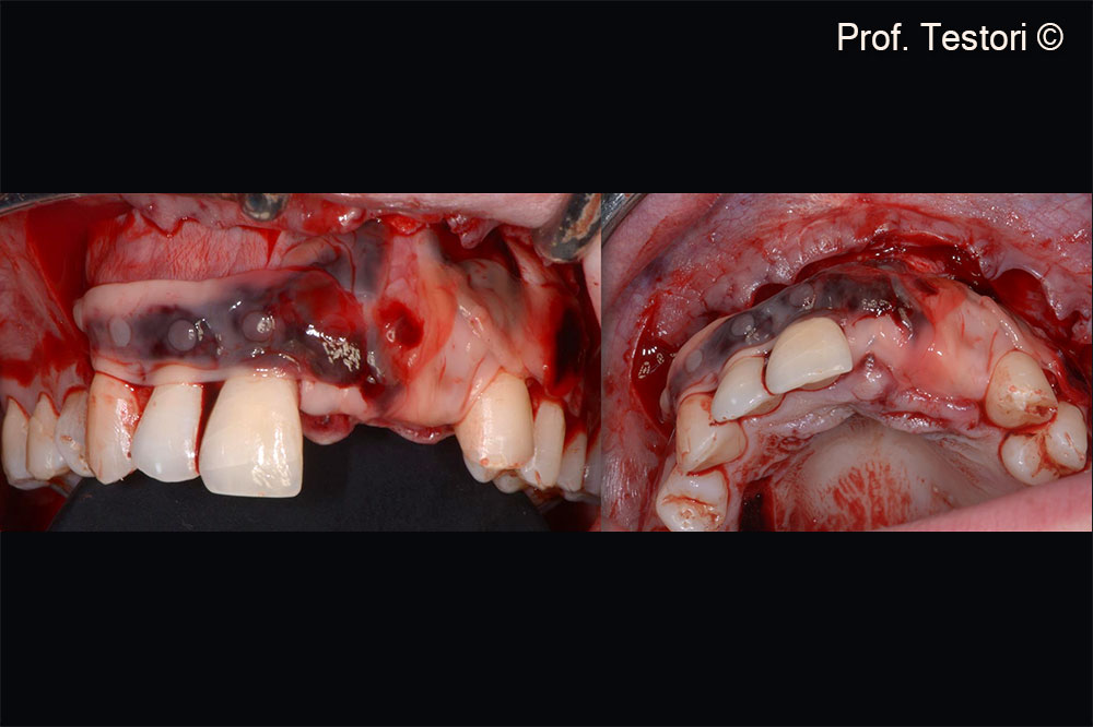 PRF membranes are used to boost soft tissue healing