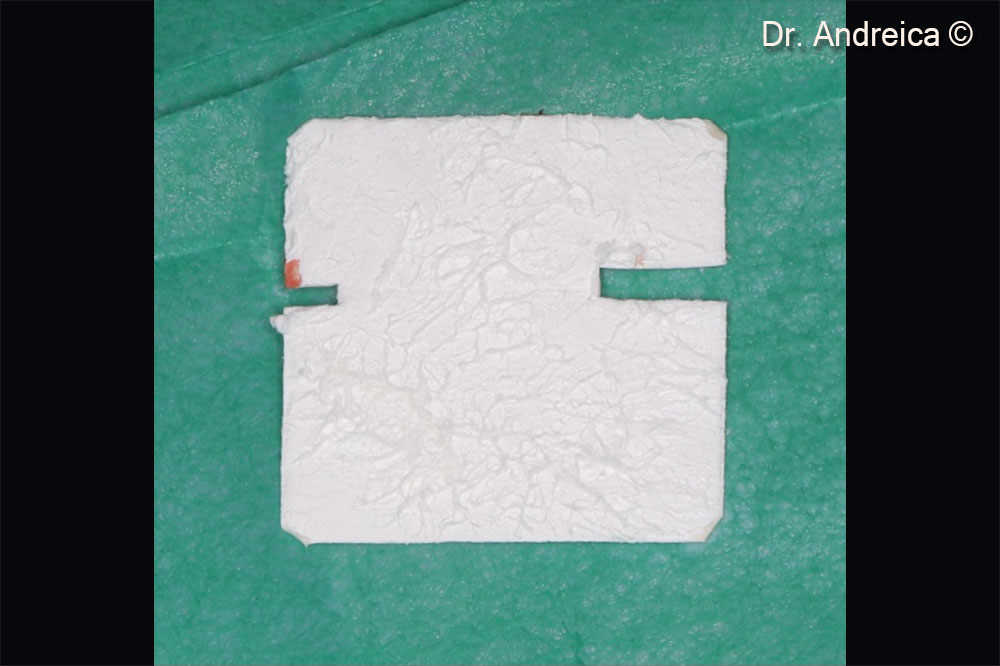 Evolution Membrane STD 30 x 30mm, trimmed and folded to cover the perforation and secure the crestal horizontal augmentation