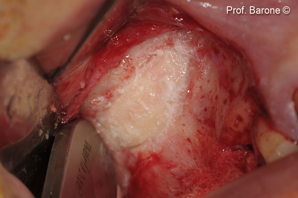 Osteotomy window was stabilized with a surgical glue