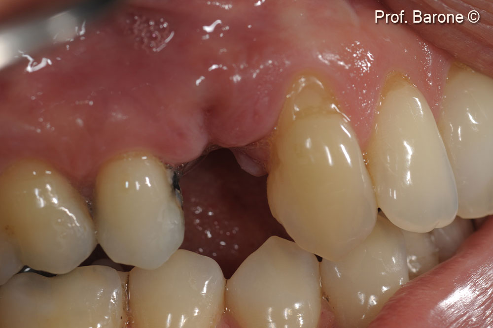 Grafted sites 6 weeks after ridge preservation. The good gingival healing should be observed.