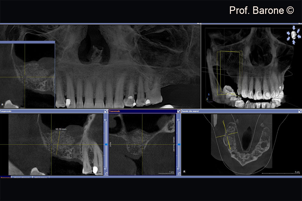 X-Ray examination 7 months after Sinus Lift