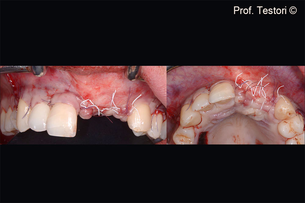 Soft tissue flaps are sutured