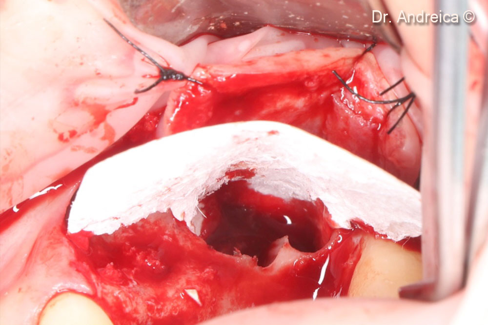 The smaller part of the membrane coresponds to the sinus width and will be fixed under the schneiderian  membrane by the bone graft. The bigger part stays outside the sinus and will cover the horizontal graft