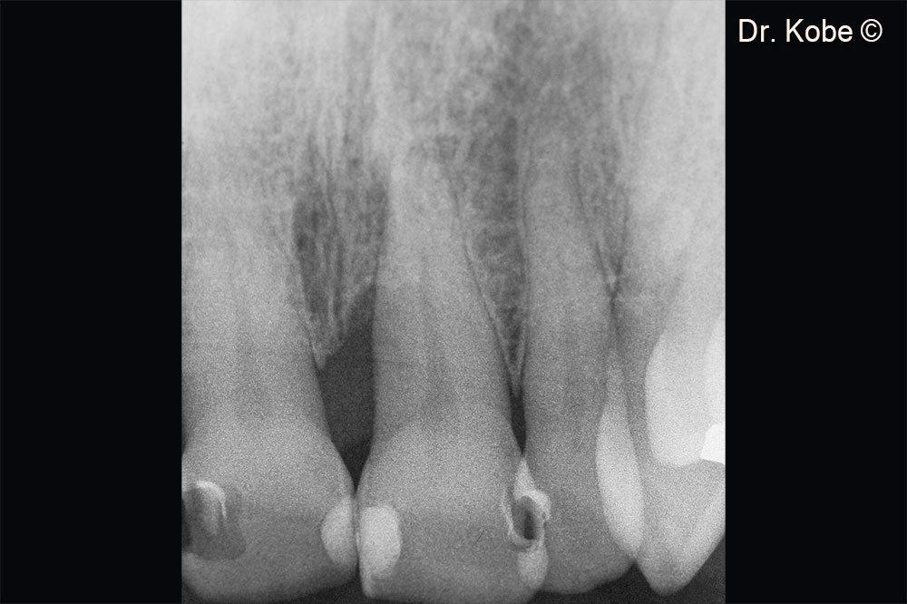 Vertical bone defect visible on the radiograph