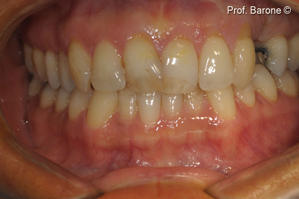 Clinical frontal view 16 weeks after ridge preservation