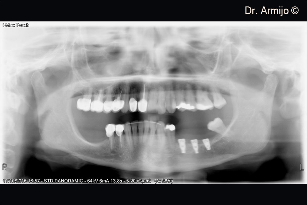 Post-surgery X-ray of implants