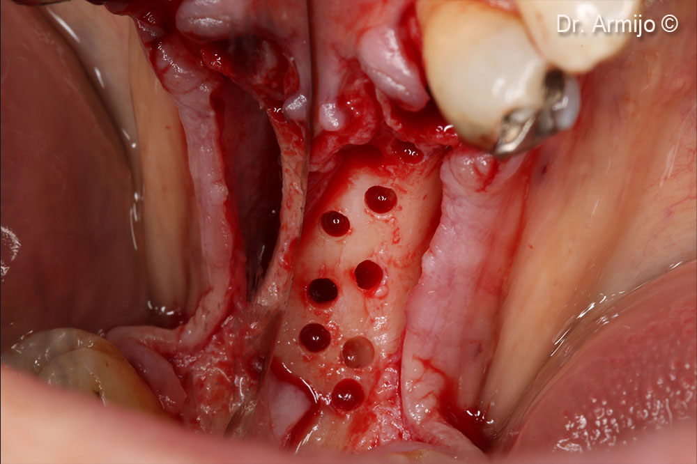Perforations down to the medullary bone.