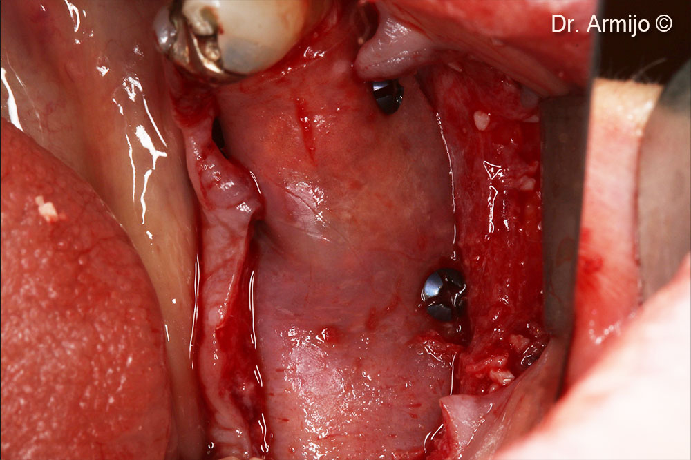 Placement of Apatos® and Lamina® Curved anchored with micro-screws