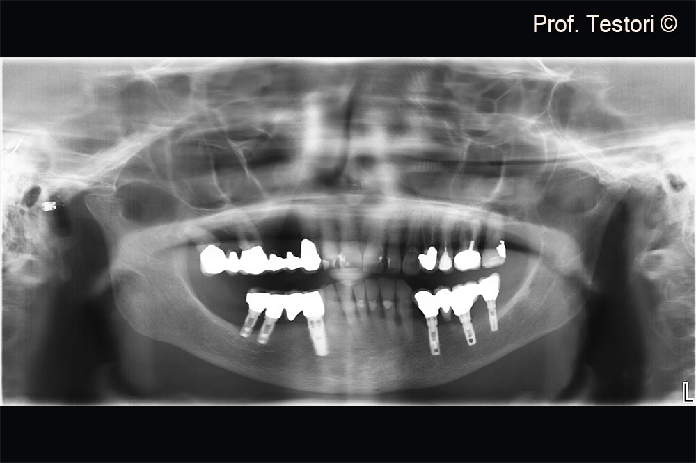 Radiographic evaluation at consultation visit.