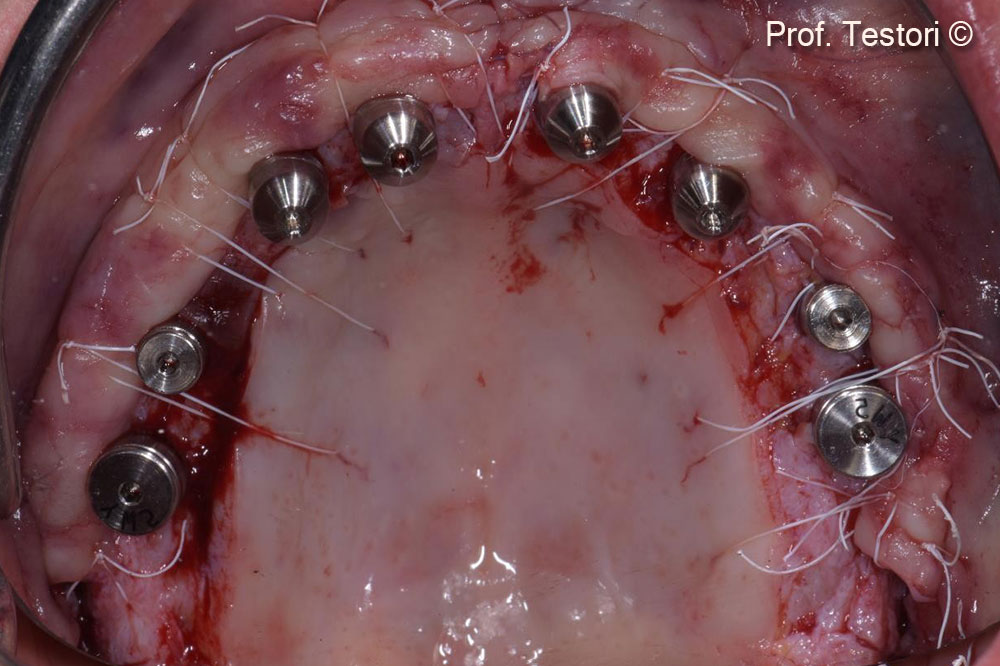 Final sutures of the fourth surgical step.