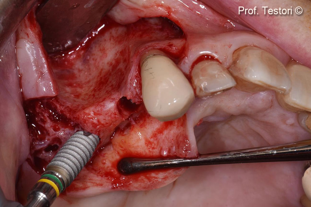 Implant placement.