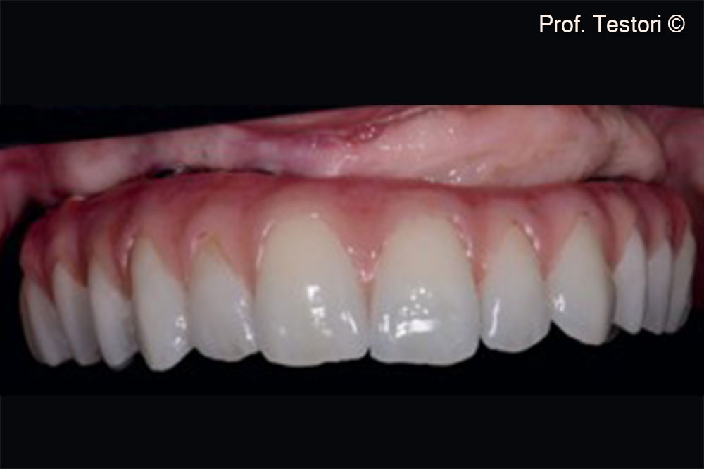 Intra-oral image of the definitive prosthesis.