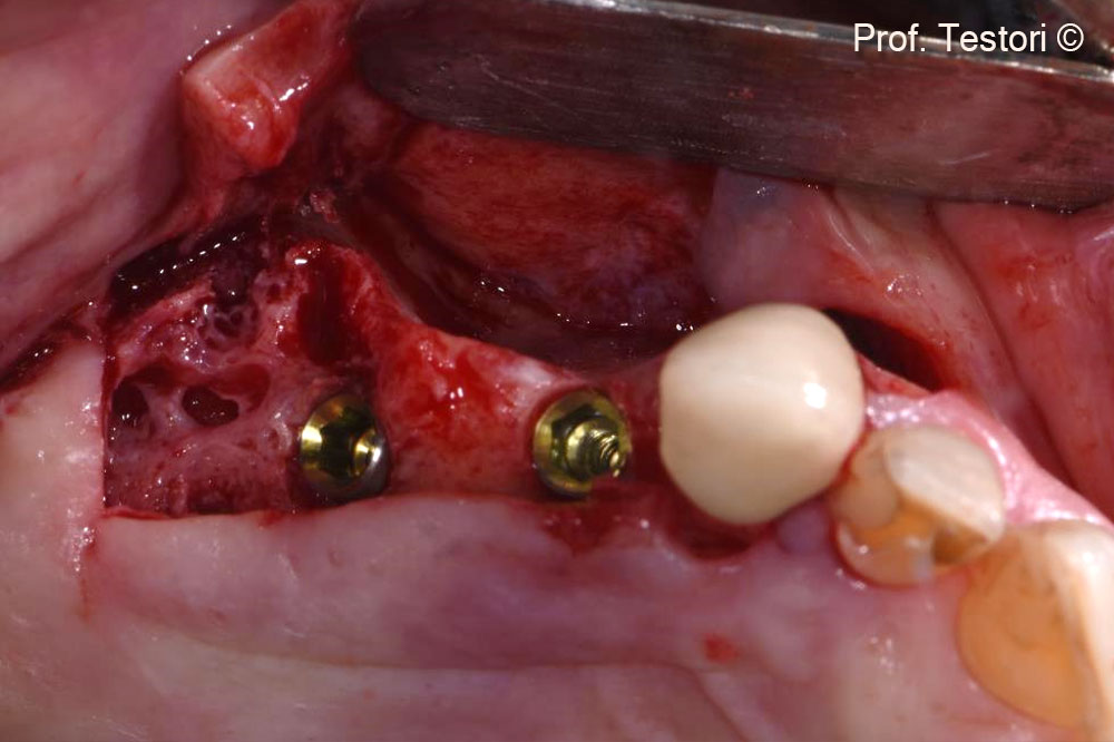 Occlusal view of the horizontal bone defect around the dental implants