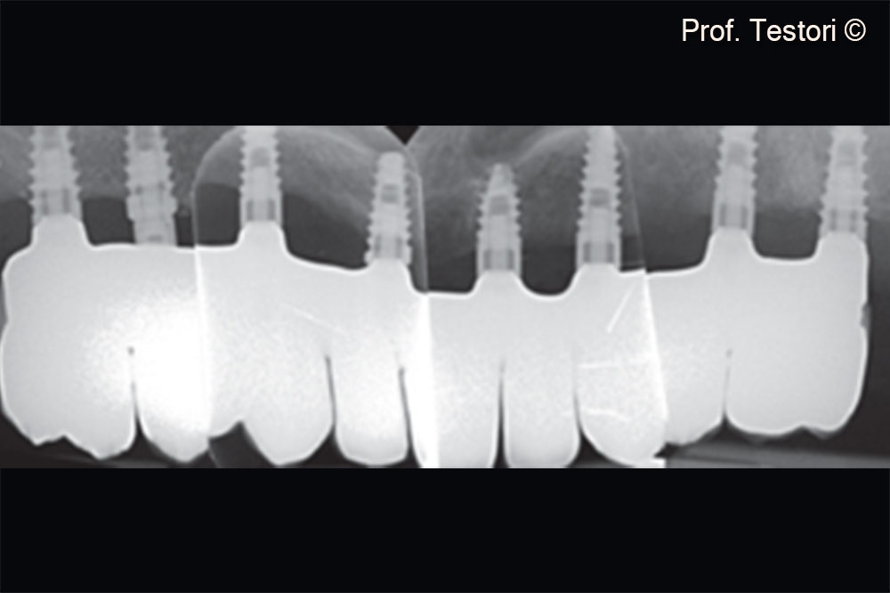 Periapical radiograph of the definitive prosthesis.