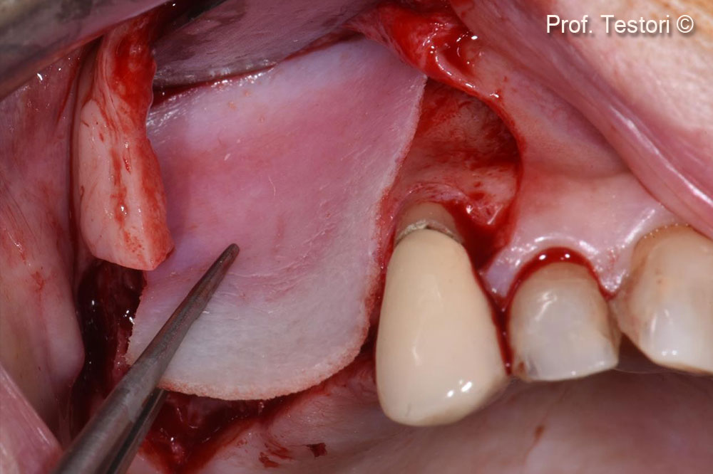 Lamina® is adapted to the defect.
