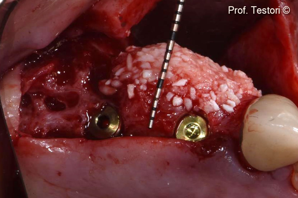 Mix of Gen-Os®, Apatos®, and fibrin sealant in place.
