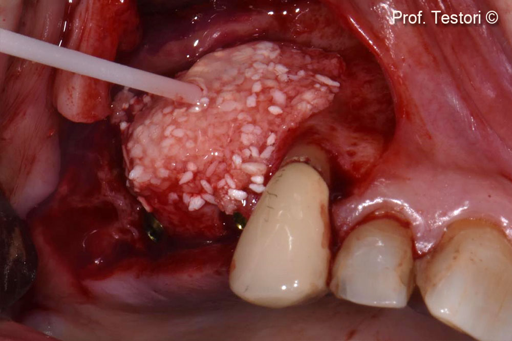Fibrin sealant is applied over the bone particles to allow Lamina® adhesion