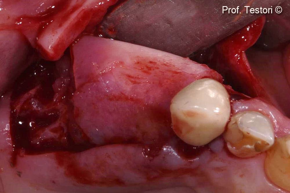 Lamina® is placed with slight pressure.