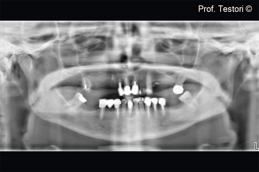 Pre-operative radiograph