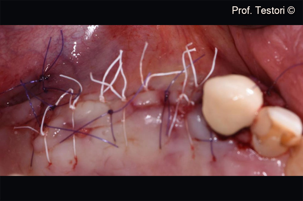 Flap suture after the GBR.