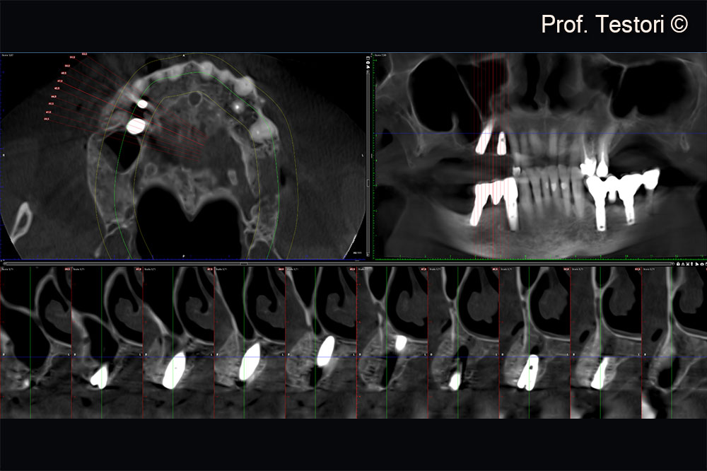 Postoperative cone-beam computerized tomography exam.