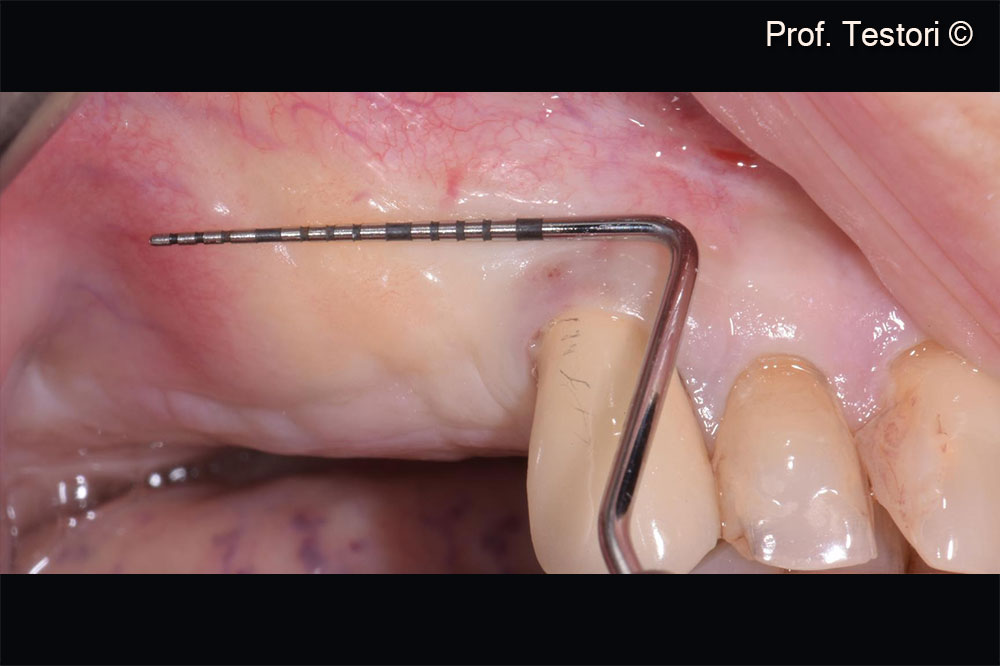 Soft tissue healing after 5 months. Healing at the augmented site
