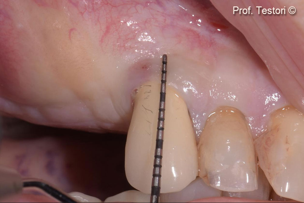 Soft tissue healing after 5 months. Soft tissue evaluation of the adjacent tooth.