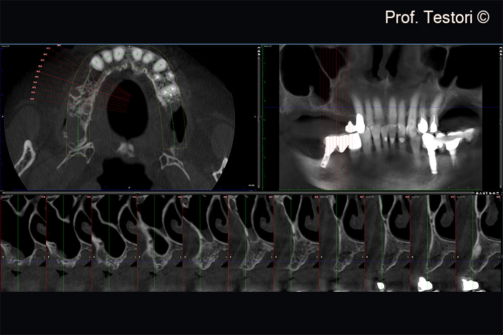 Cone-beam computerized tomography exam after 4 months of healing.