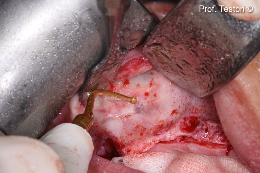 Antrostomy design by means of piezo-surgery