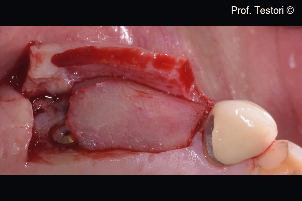 Second stage surgery. Flap design.