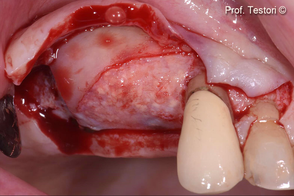 Bone regeneration after Lamina® removal