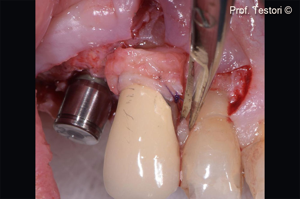 Soft tissue augmentation at adjacent tooth.