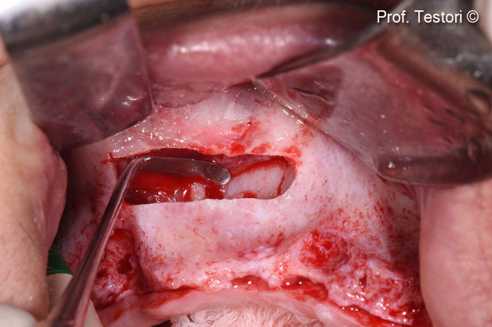 Elevation of the Schneiderian membrane