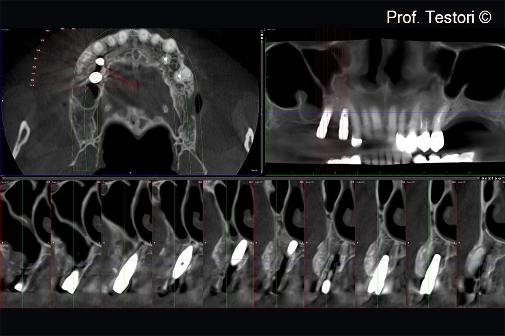 Cone-beam computerized tomography examination after second stage surgery.