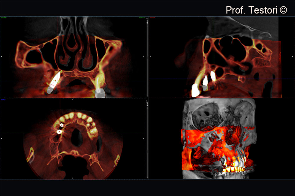 Three-dimensional superimposition of the CBCT after the first (gray) and second (red) stage surgery using Romexis.