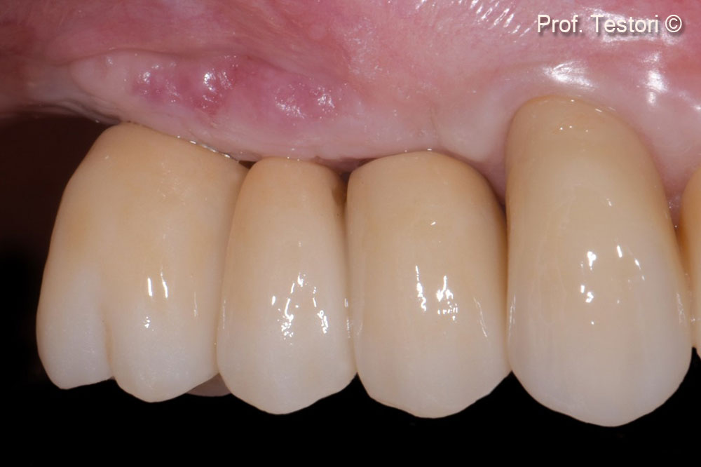 Definitive prosthesis delivery on buccal view.
