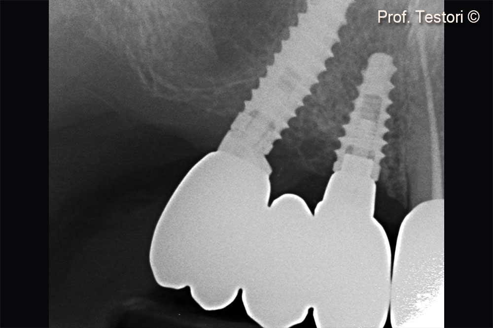 Peri-apical x-ray at definitive crown delivery after 4 months.