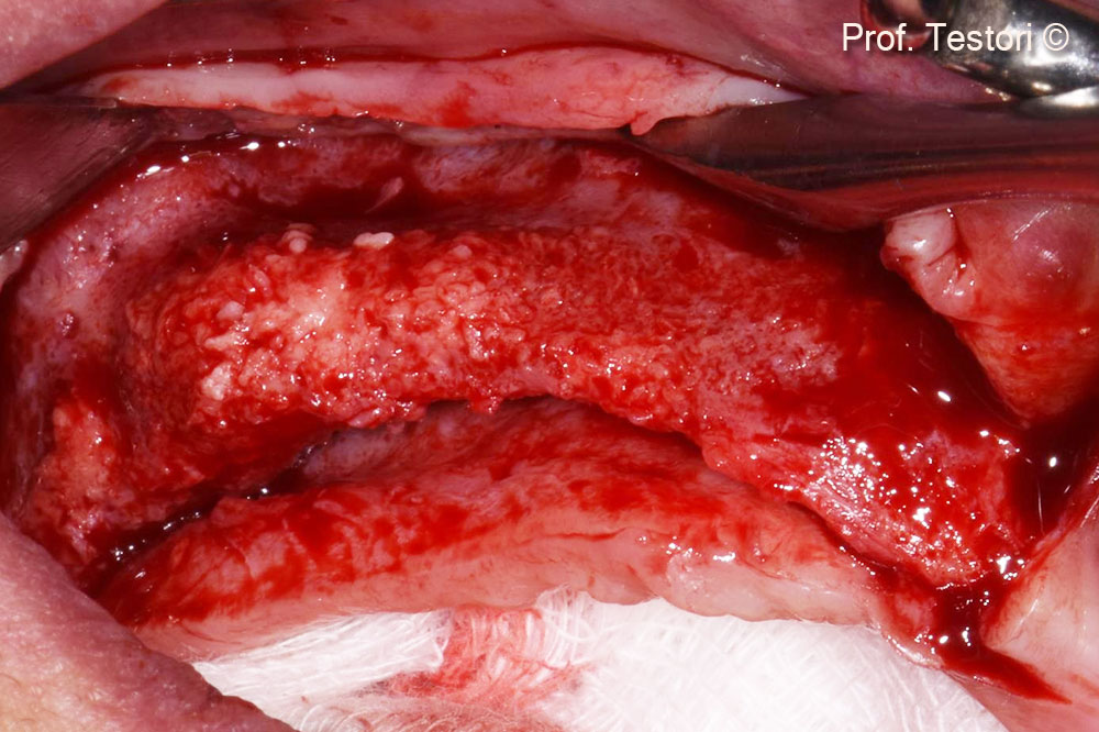 Result of the first horizontal augmentation of the right side.