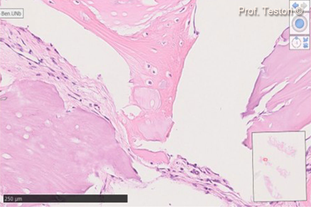 This image is showing particlesof the Gen-Os®  totally surrounded by newly formed bone. Biomaterial is acellular but has the same physiological properties as bone; hence, new bone is forming around the particles.