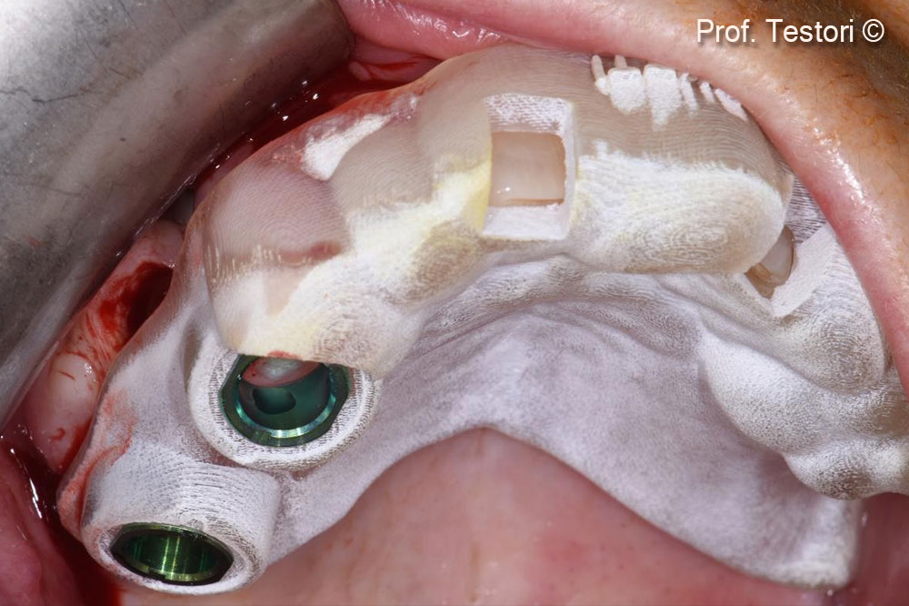 The fit of the tooth-supported surgical template is carefully tested